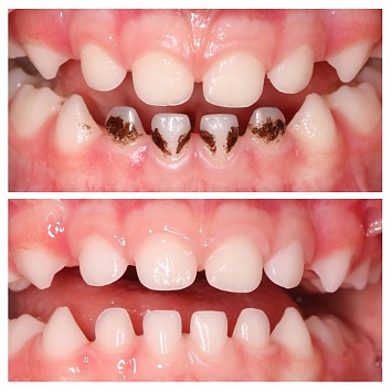 Черный налет на зуба: как можно счистить? 