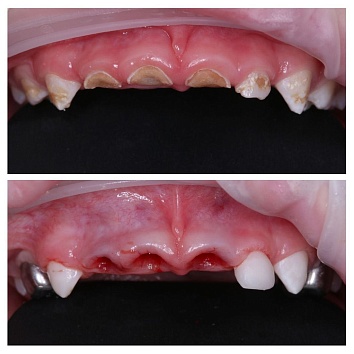 Лечение большого количества зубов под наркозом