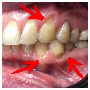 Абфракционный дефект зубов.