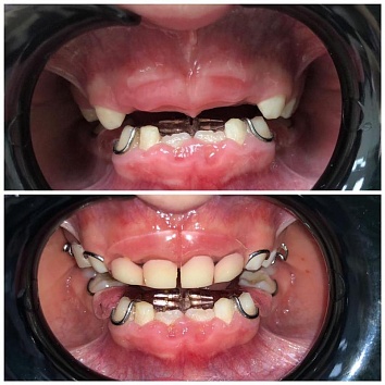 Ортодонтическое лечение: заместительная пластинка.